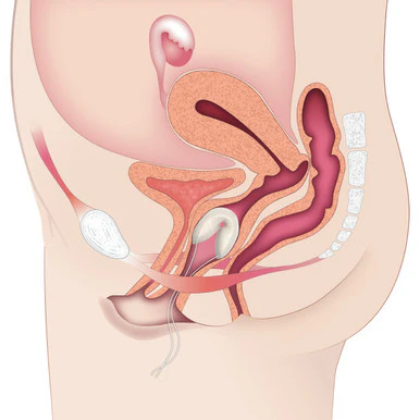Contrelle Activgard Bladder Support Sizing Kit 1 Kit - Image 3