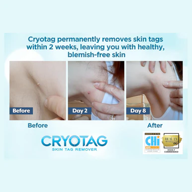 Cryotag Skin Tag Remover 12 Treatments - Image 4