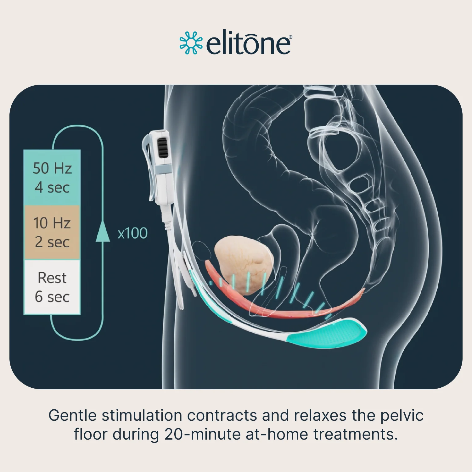 Elitone Female Incontinence Therapy Kit - Image 5