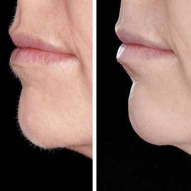 Hollywood Smoother, Sonic Dermaplaner- Rose Gold - Image 2