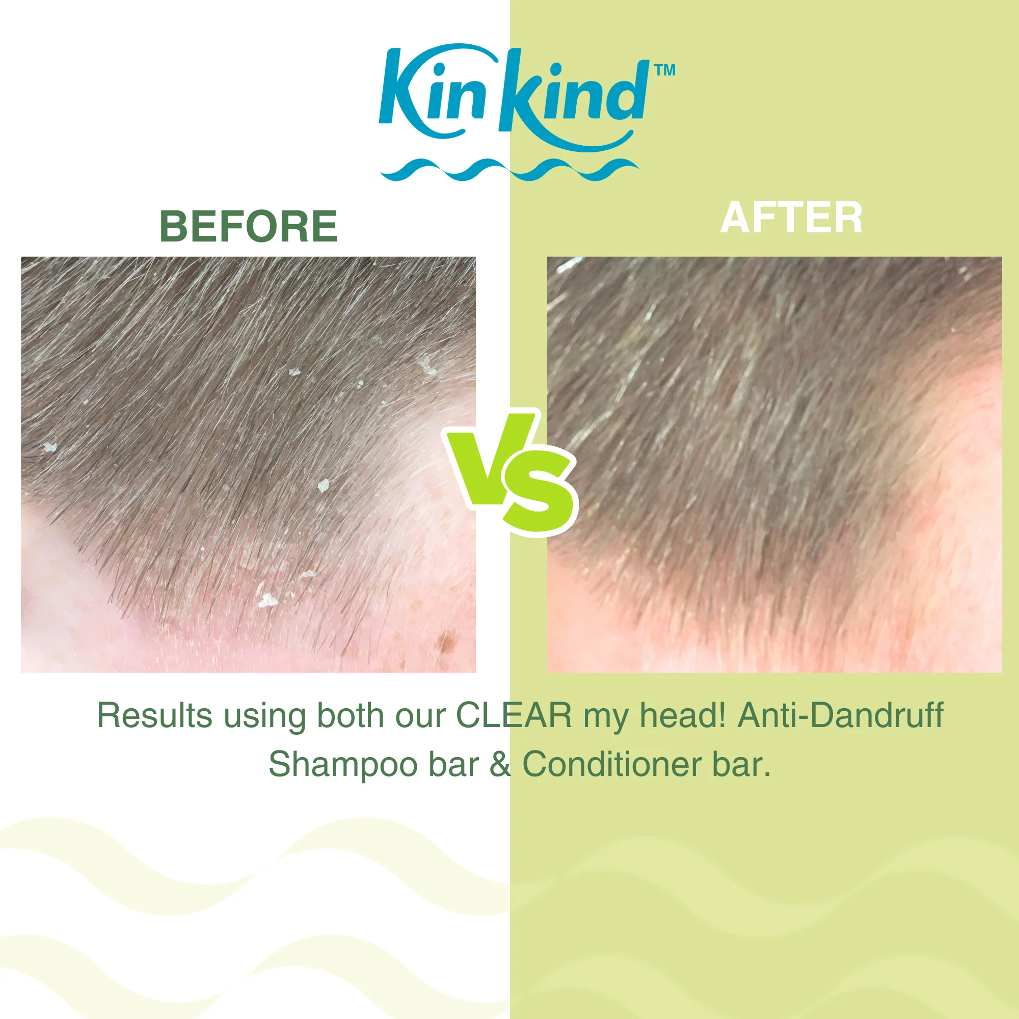 KinKind CLEAR my head! Anti Dandruff Shampoo Bar Apple 50g - Image 5