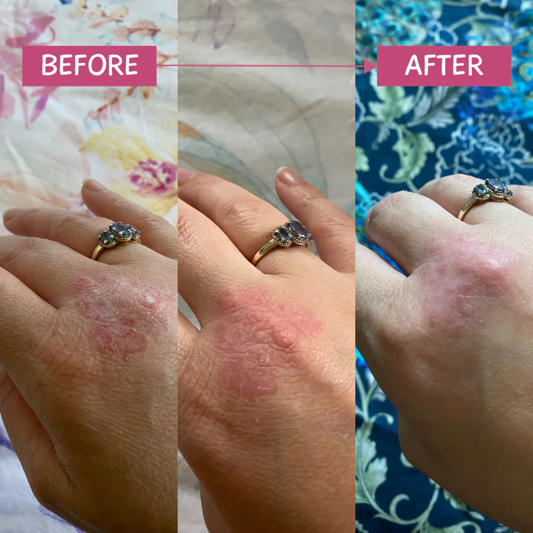 MooGoo Pink Eczema Cream 120g - Image 4