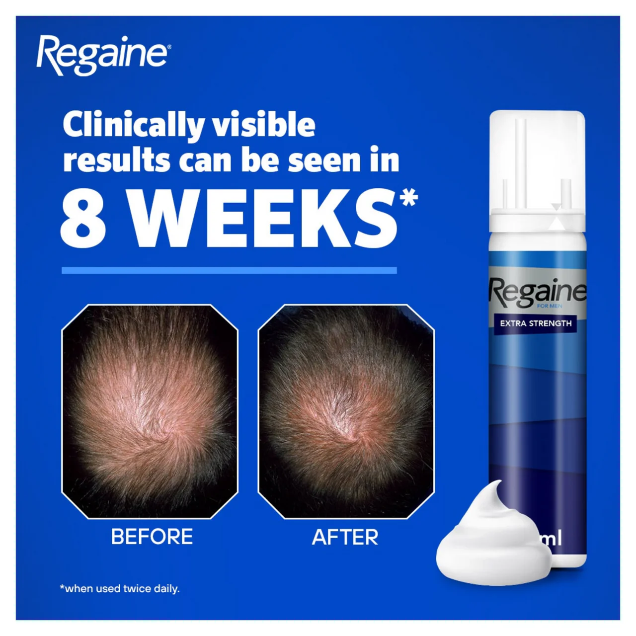 Regaine 5% Extra Strength Hair Regrowth Foam For Men - 3 Month Supply 3x73ml Bottle - Image 7