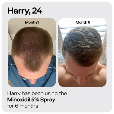 Sons Minoxidil 5% Spray 1 Month - Image 4