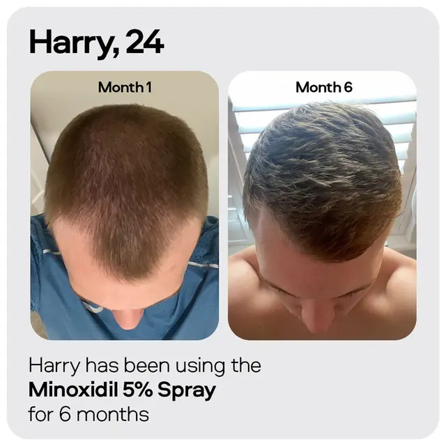 Sons Minoxidil 5% Spray 3 Pack x2 - Image 5
