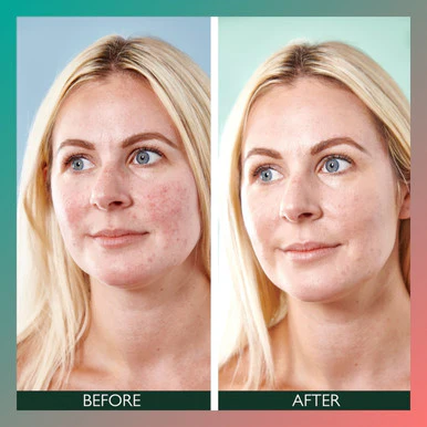 Sorted Skin 5 in 1 Anti-Redness Day Cream SPF50 30ml - Image 4
